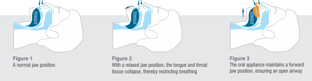 Mandibular Advancement Devices